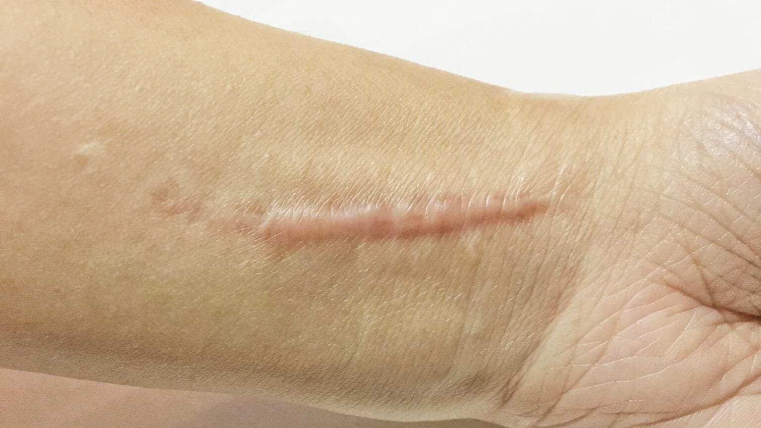 Scar Contracture Example Scars