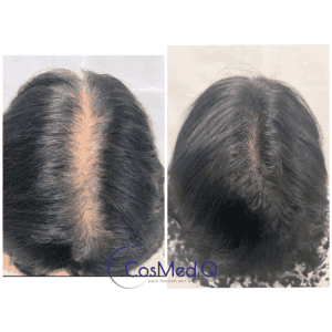 Before and after results of Hair restoration treatment for female pattern baldness, showcasing restored hair density.