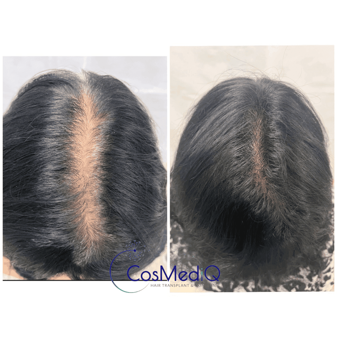 Before and after results of Hair restoration treatment for female pattern baldness, showcasing restored hair density.