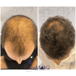 Visible hair restoration results with Hair restoration for hair thinning – before and after comparison.
