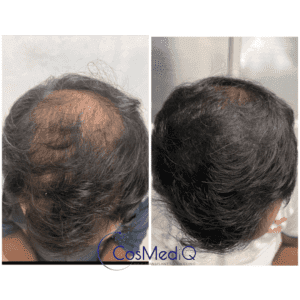 Hair restoration therapy results for hair loss treatment – dramatic improvement in hair thickness and regrowth