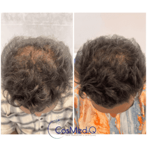 Before and after images of hair loss treatment, highlighting improved hair density and growth.