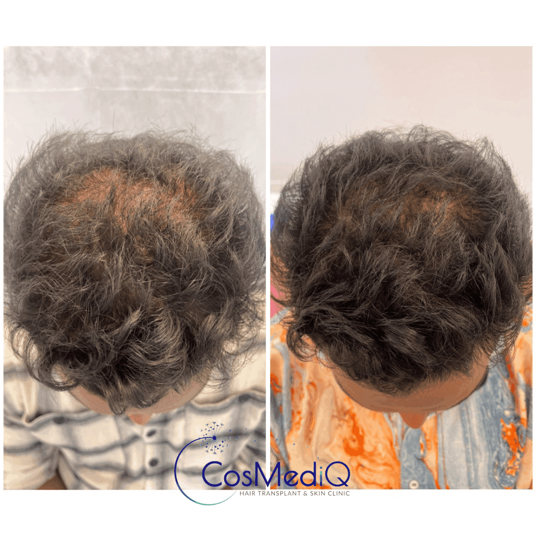 Before and after images of hair loss treatment, highlighting improved hair density and growth.