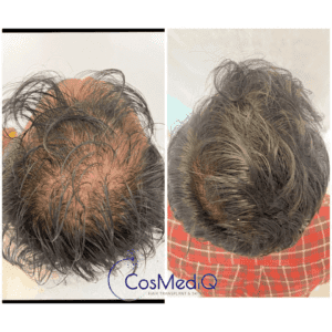 Hair restoration treatment before and after results showcasing significant hair regrowth and restored thickness for hair loss.