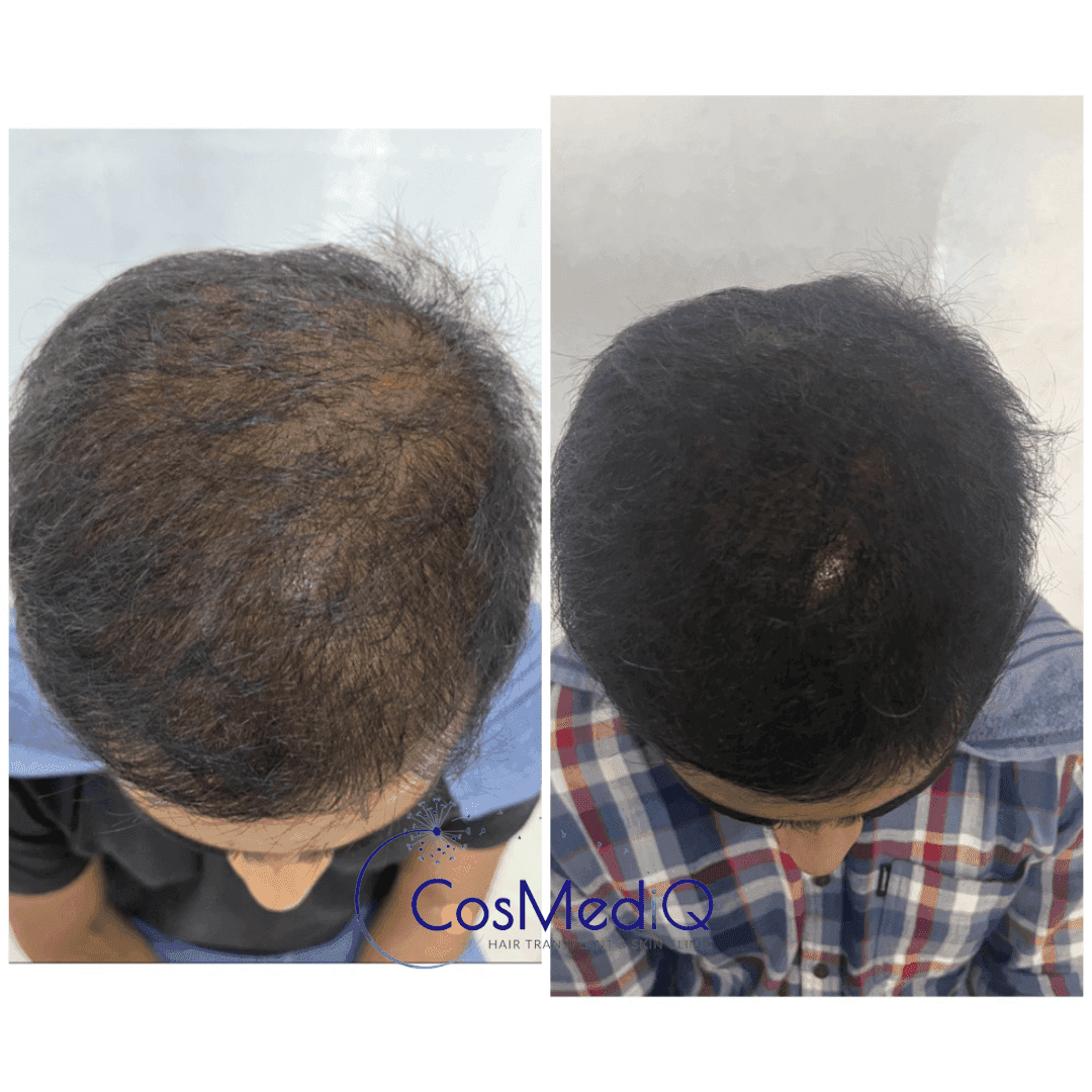 Before and after results of Hair restoration treatment for hair loss, highlighting visible hair regrowth and improved thickness through Hair restoration.