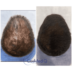 Hair regrowth before and after Hair restoration treatment, showing effective hair restoration for thinning hair
