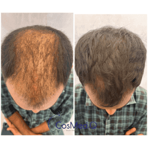 Before and after images of Hair restoration treatment for hair loss, showing results that resemble a hair transplant but achieved non-surgically.