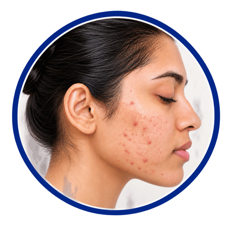 Acne Round